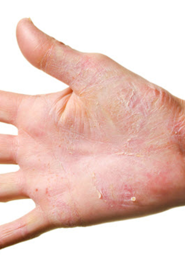 تشكَل الأكزيما الجلدية مشكلةً صحية كبيرة للمصابين بها