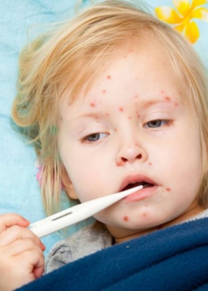 يجب ابعاد الطفل المصاب عن الآخرين لتجنب العدوى