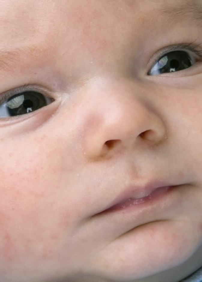 حمو النيل عند الرضع في فصل الصيف اسبابة وطرق علاجه