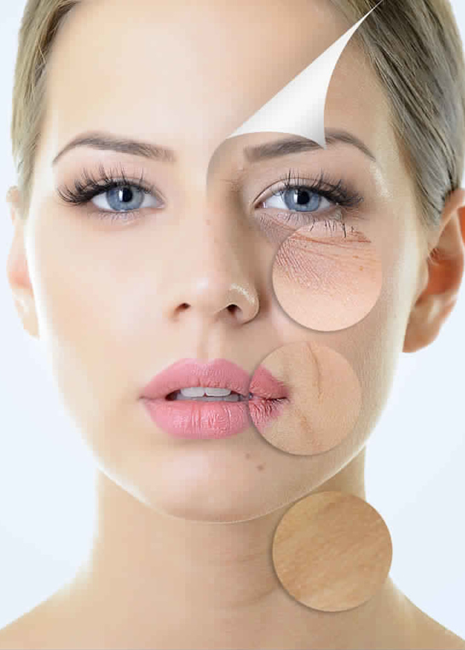 اثار البثور تسبب متاعب نفسية للعروس