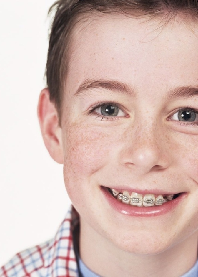 انواع تقويم الاسنان