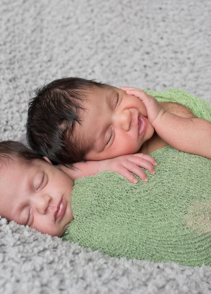 توأم سيامي بعد عملية فصلهما