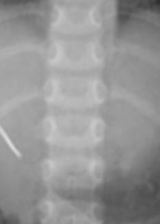 جراحة غريبة لطفل سعودي ابتلع دبوساً... فهل نجا؟