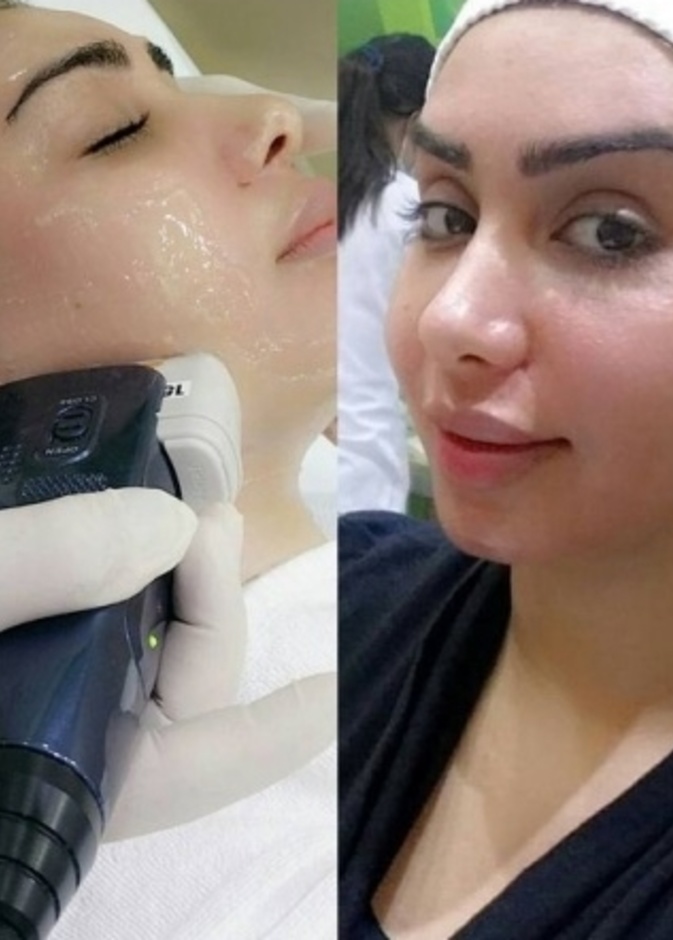 هنادي الكندري تخضع لجلسة شد الوجه