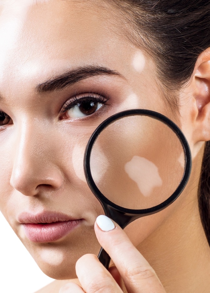 طرق طبيعية لعلاج البهاق في الوجه نهائياً