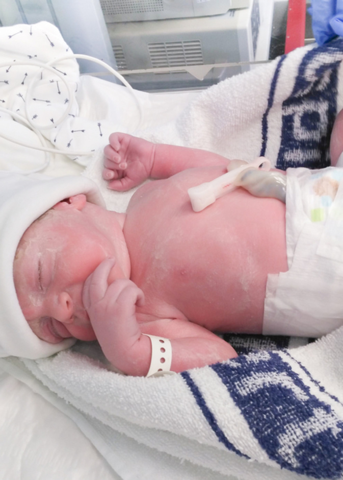 اضرار الولادة القيصرية على المدى البعيد قد تصيب الطفل بالربو والبدانة خلال مراحل نمو المتطورة