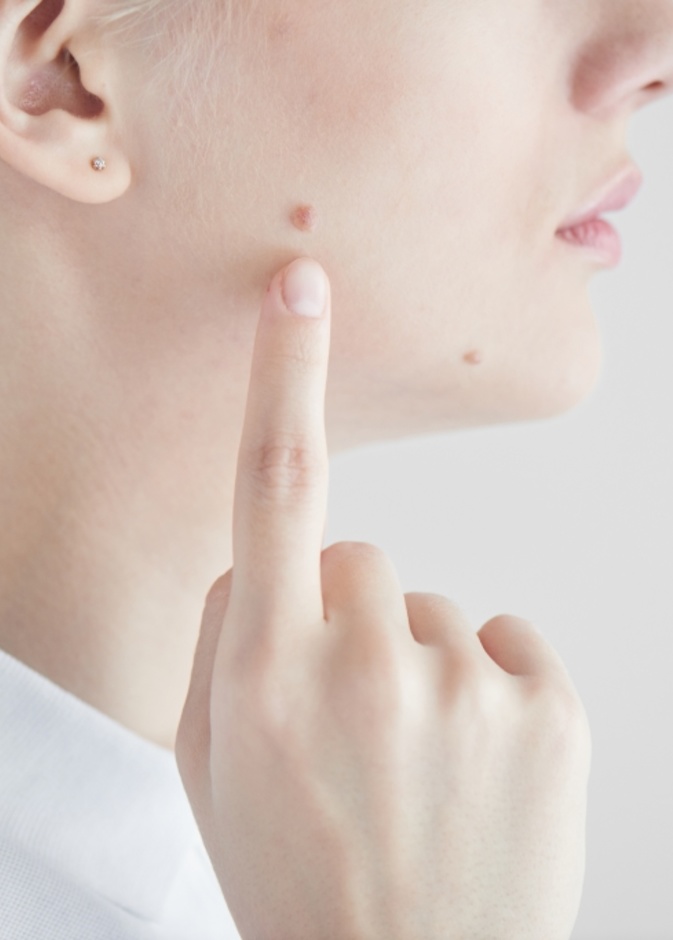 خل التفاح يساعد على التخلص من الشامات بشكل سريع