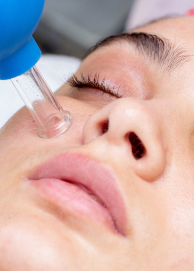 طريقة عمل الحجامة للوجه وأهم النصائح عند تطبيقها