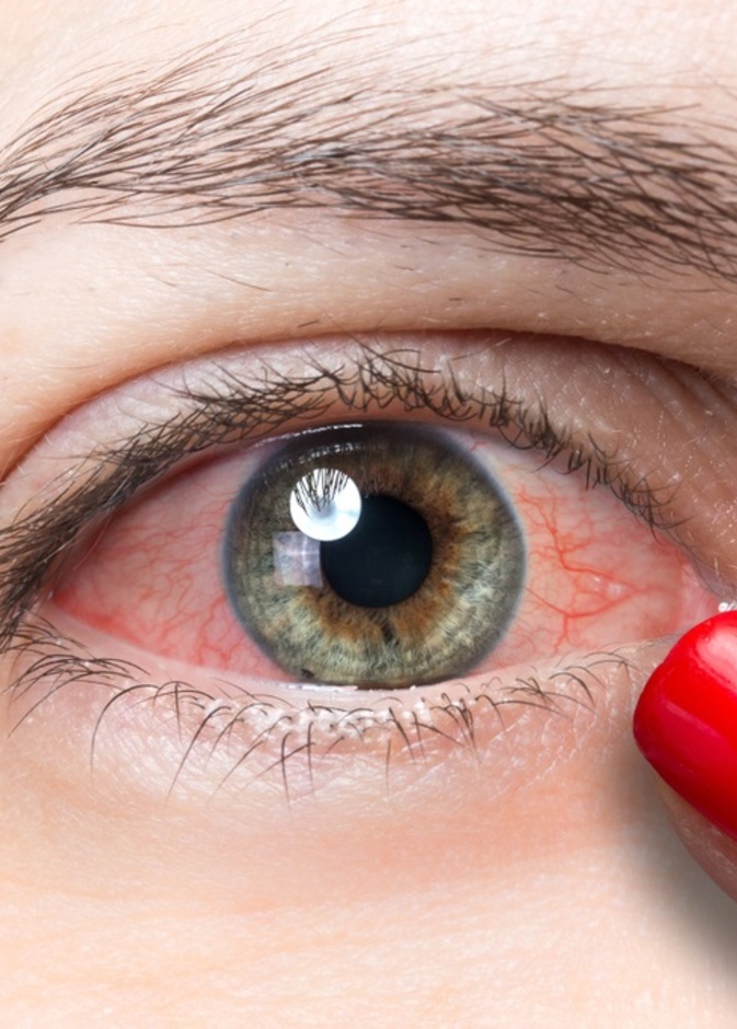 هل إحمرار العينين يعد دليلاً على الإصابة بمتحور أوميكرون