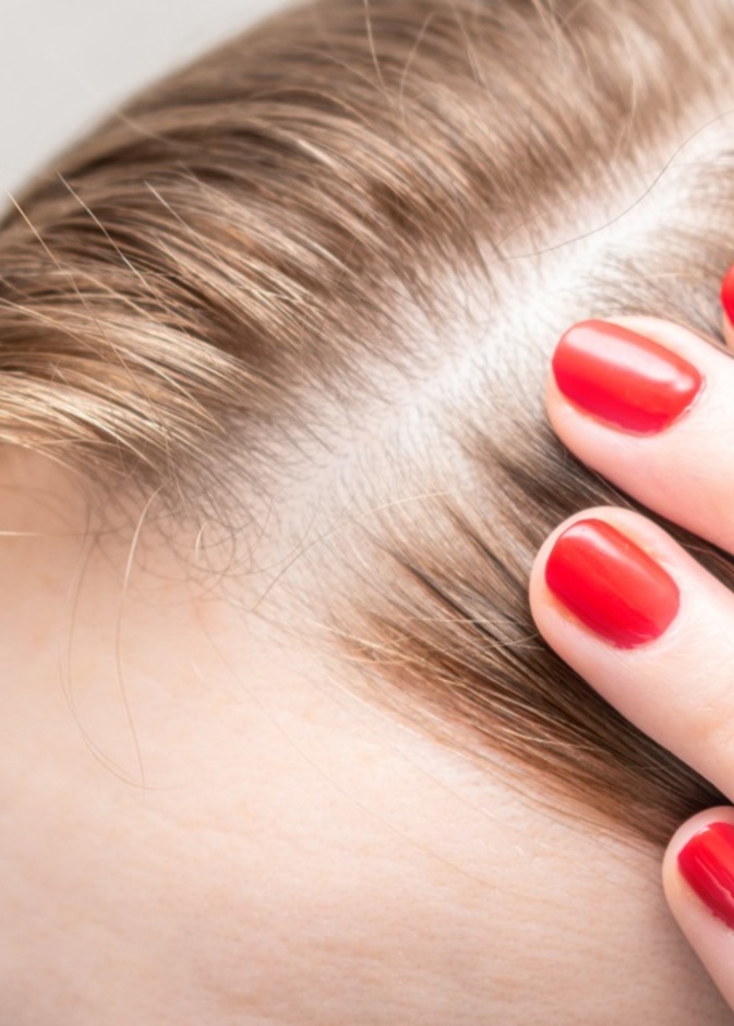 مرض الثعلبة ناجم عن عدوى فطرية تصيب فروة الرأس