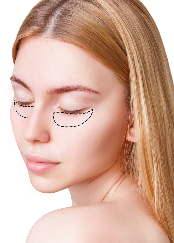 نصائح وأهم التعليمات قبل وبعد حقن الفيلر تحت العين