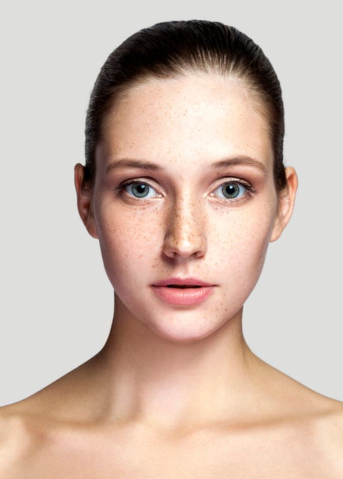 طرق إزالة النمش من الوجه تجميلياً وما هي نتائجه