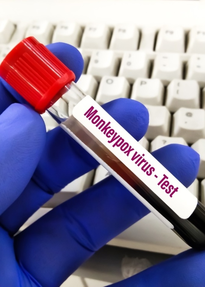 اهم اعراض جدري القرود وطرق الوقاية منه