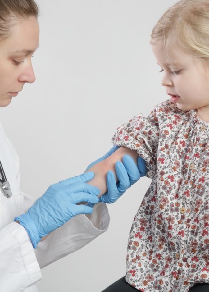 فيروس جدري القرود ومدى خطورته على الأطفال  