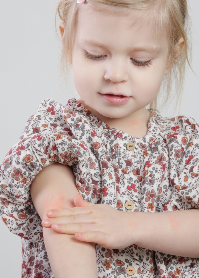 ما هي أعراض حمى الطماطم