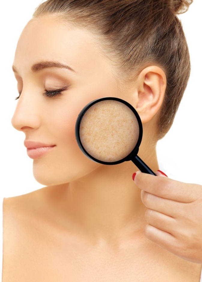 تصبغات الجلد مشكلة يمكن علاجها بالادوية والليزر