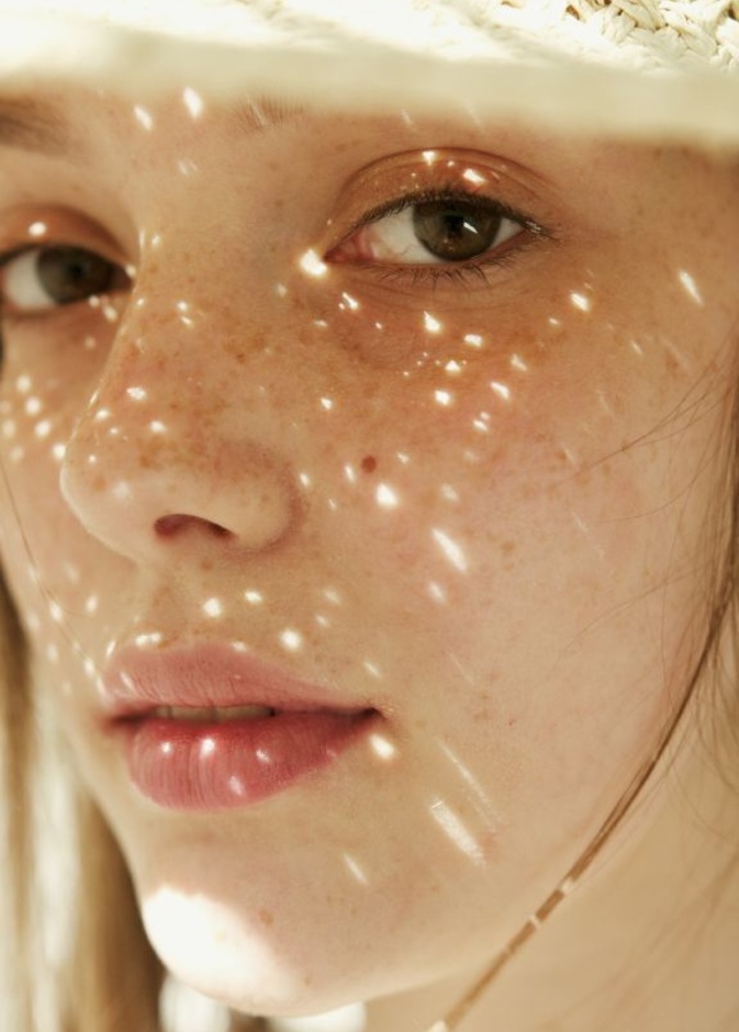 إزالة النمش والكلف في الصيف بالطرق الطبيعية وطريقة استخدامها