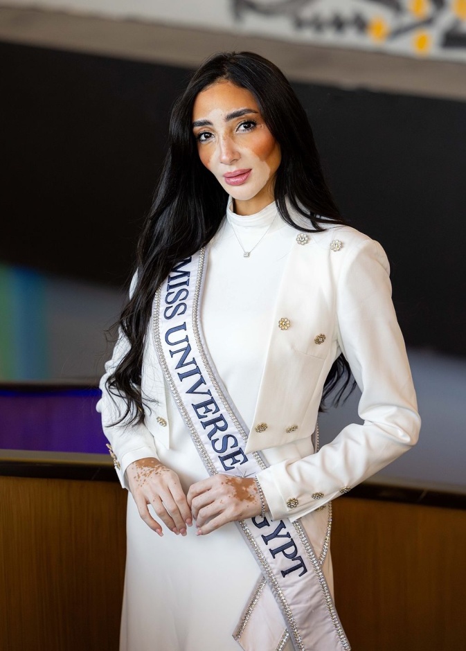 كيف تحدّت لوجينا صلاح مشكلة البهاق وفرضت حضورها في مسابقة ملكة جمال الكون 2024؟