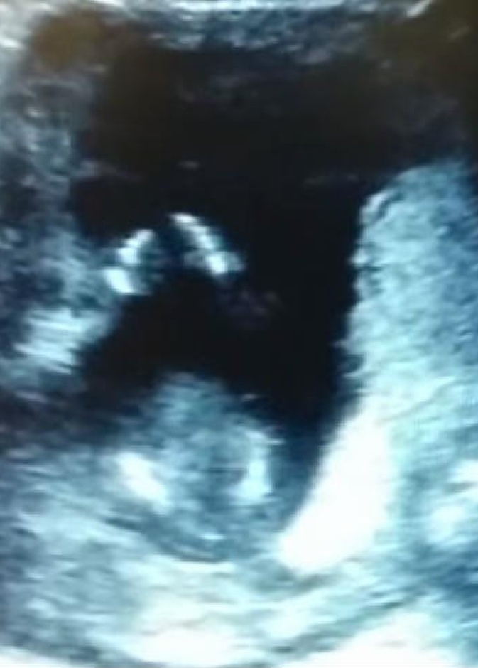 فيديو.. جنين يصفق في رحم أمه