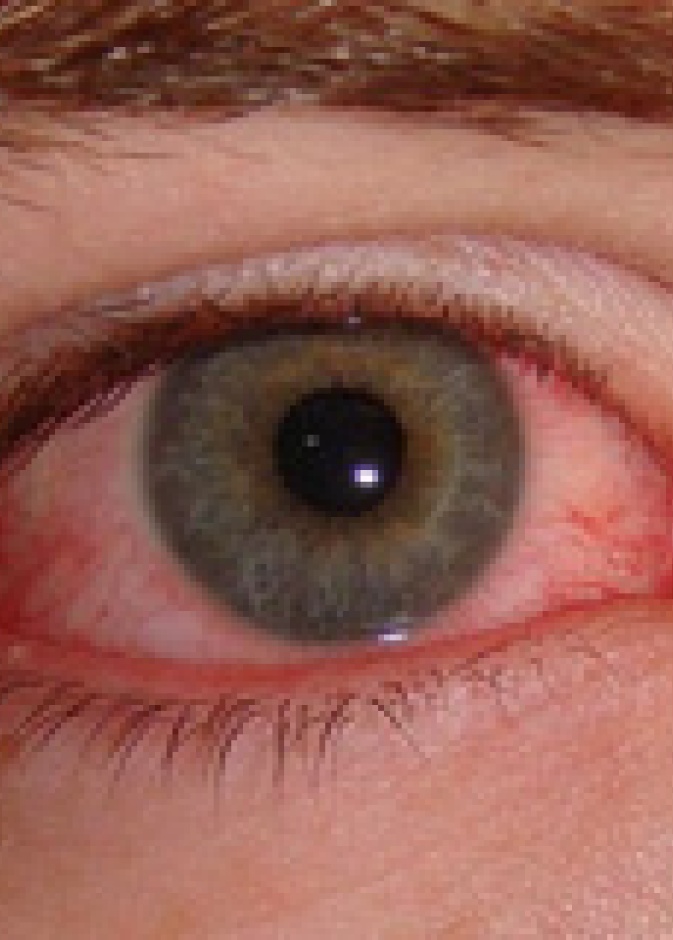 خطوات تجنب الاصابة بالرمد