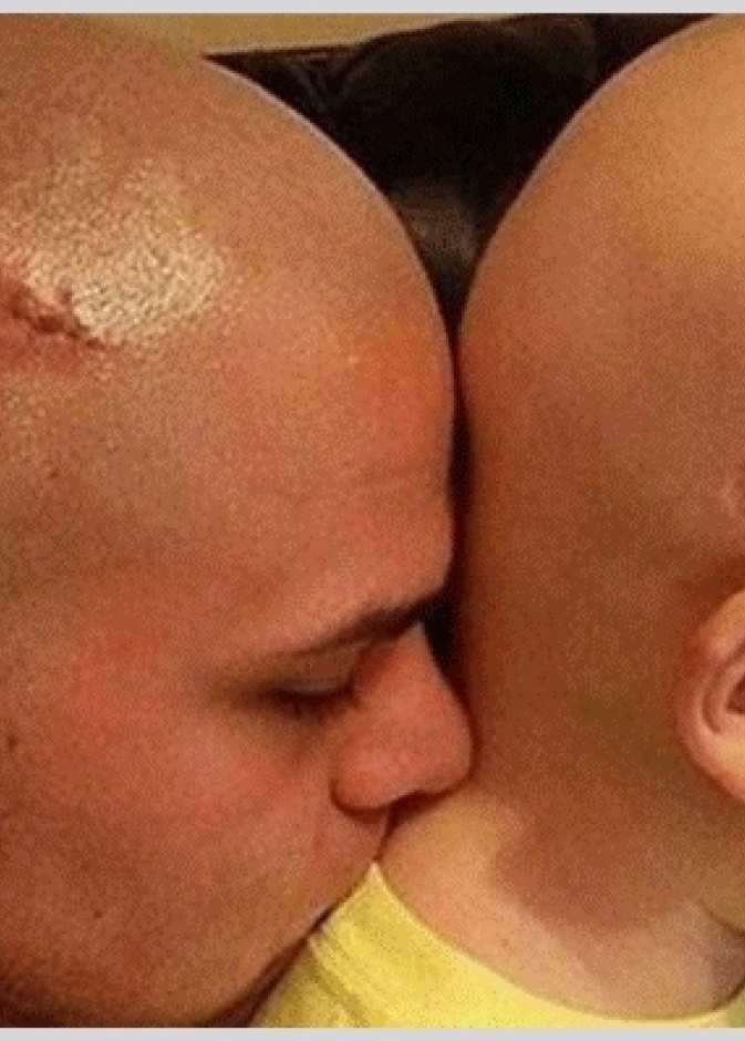 اب يحلق راسه تضامنا مع ابنه مريض السرطان