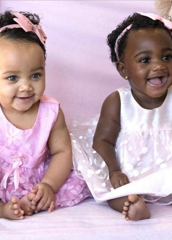 توأم غير متطابق يحقق شهرة واسعة على انستغرام