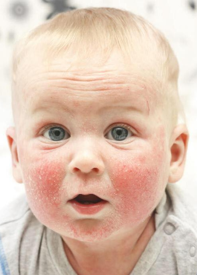 5 امراض جلدية تصيب الاطفال الرضع