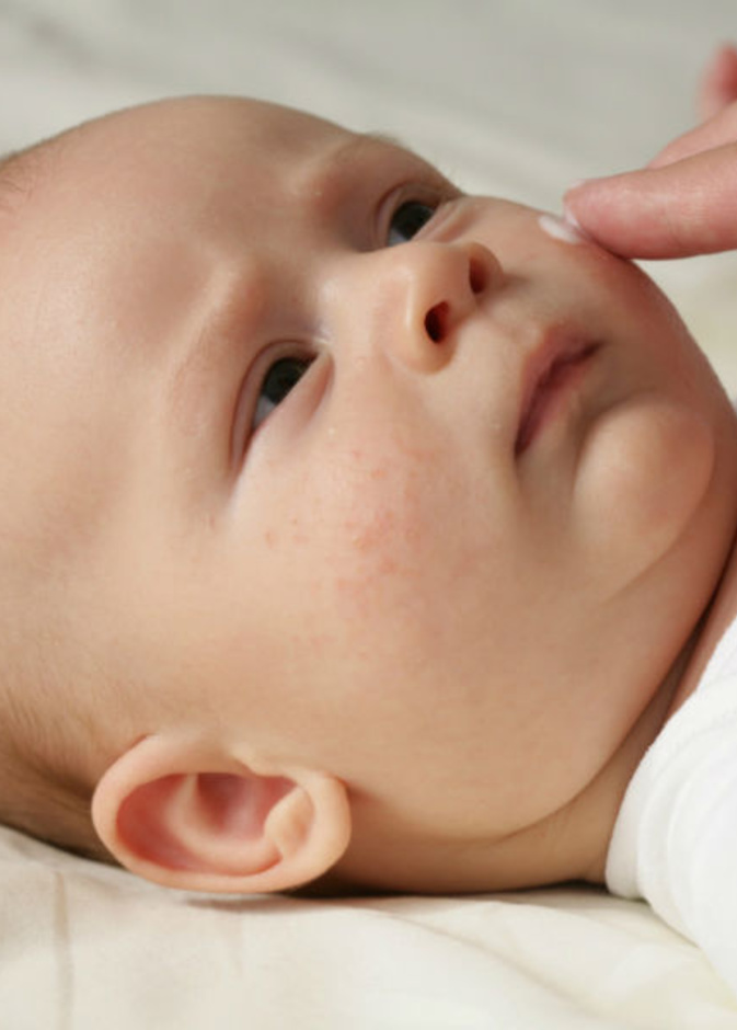 اعراض القوباء الحلقية عند الاطفال