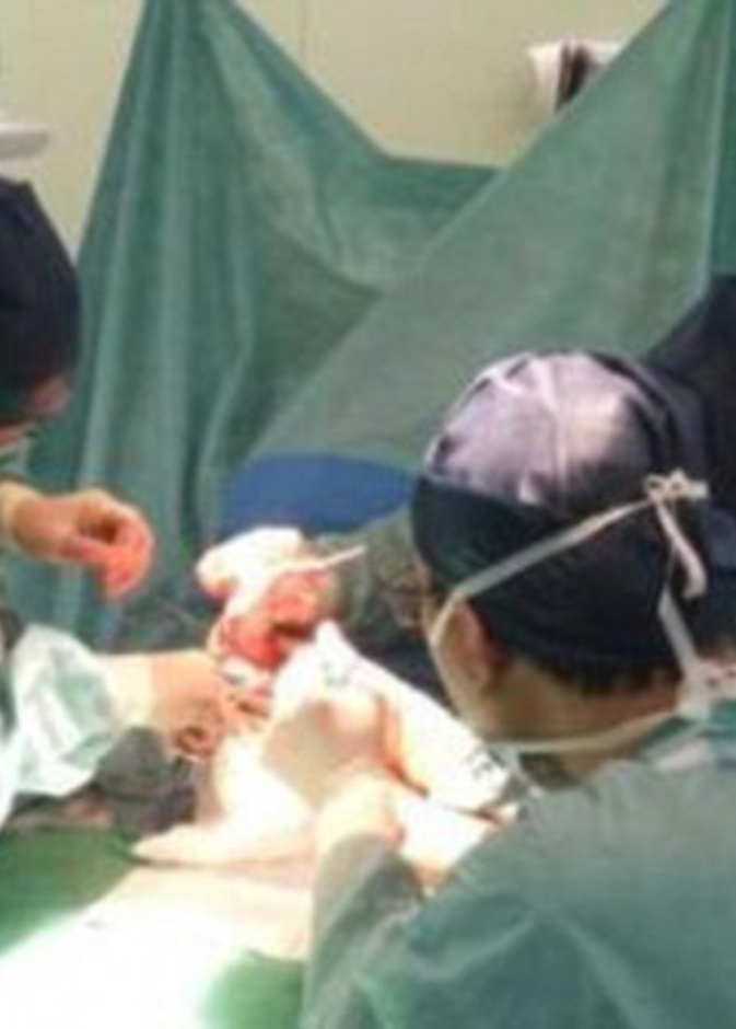 إزالة الرجل الزائدة في أول تدخل جراحي للطفل