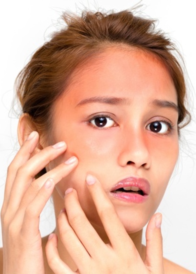 علاج  حروق الشمس