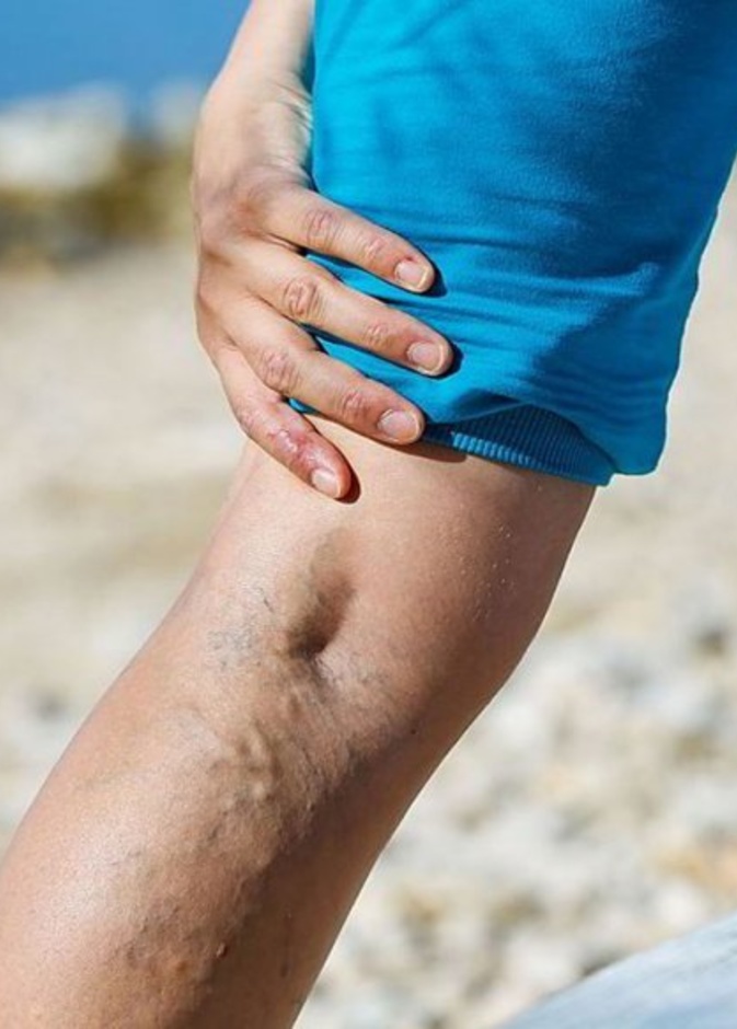 نصائح بعد عملية دوالي الساقين