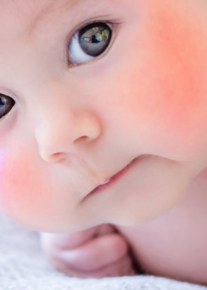 علامات إصابة الأطفال بالإكزيما وطرق الحماية منها