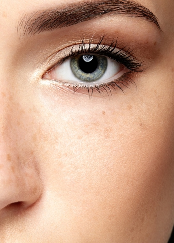 الجراحة الليزرية لإزالة النمش دائمة، لكن هذا لا يعني أن النمش لا يمكن أن تعود للظهور مرة أخرى