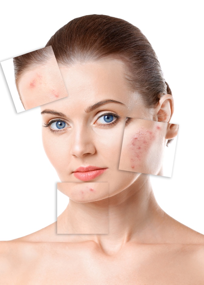 تعرفي على ابرز تقنيات معالحة ندوب حب الشباب