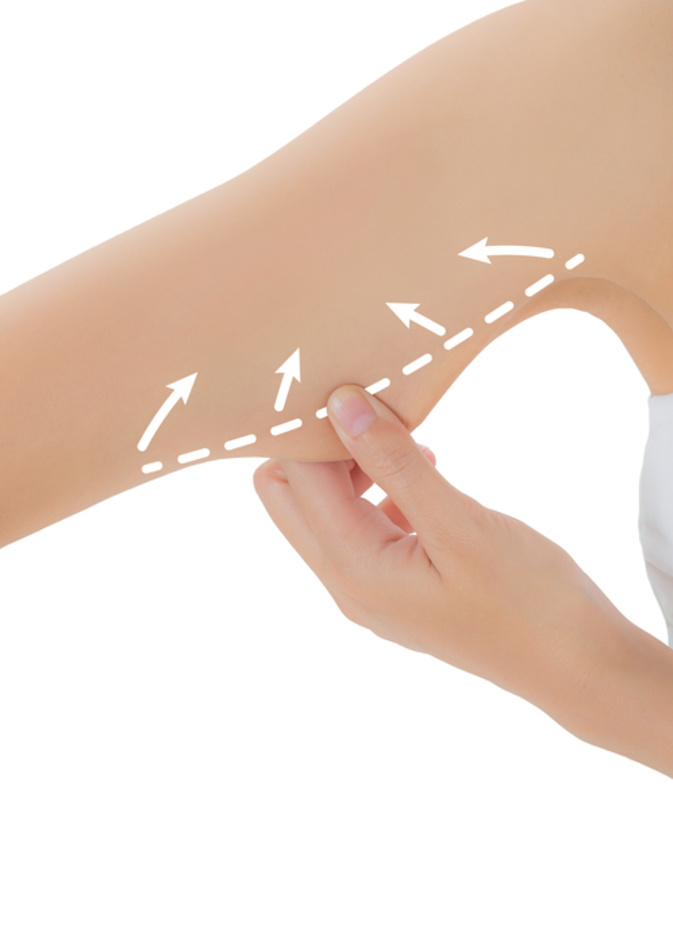 تخلصي من السيلوليت من خلال تقنية الليزر أو تقنية سيلفينا