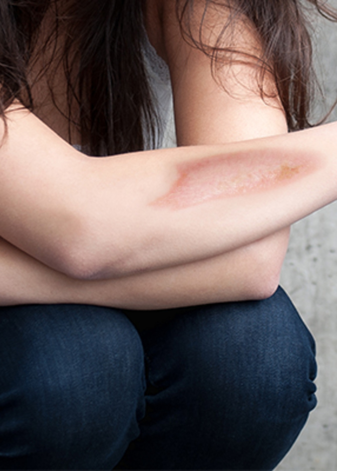 الليزر تقنية مهمة وفعّالة لإزالة الحروق عن الجسم