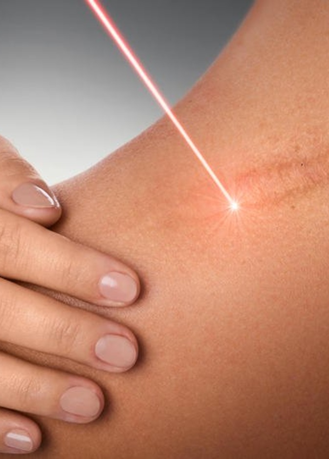 الليزر يساعد على تقليل الجروح وجعلها أكثر اتساقاً مع مظهر الجلد حولها