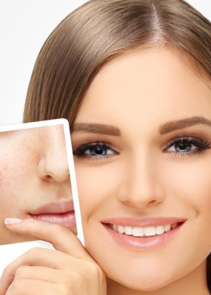 اخفاء حبوب الوجه بالمكياج