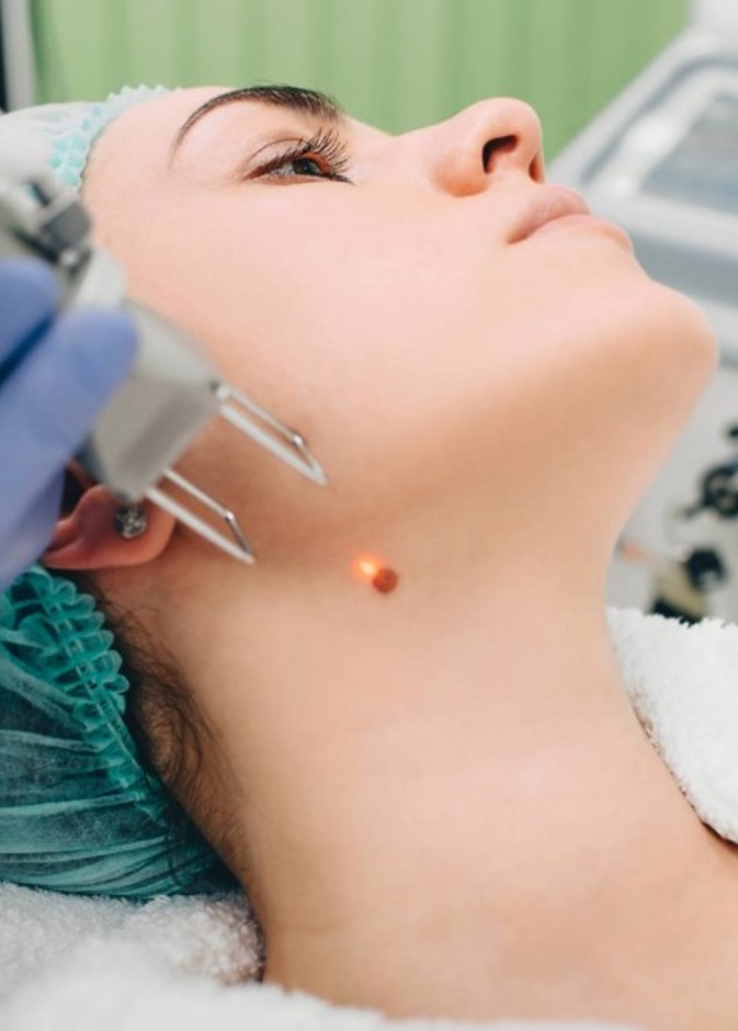  الليزر سيساعدك على التخلص من أي شامة في جسمك بطريقة سهلة وسريعة