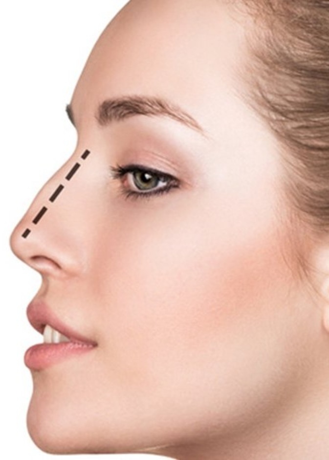 احصلي على أنف صغير مثالي من خلال خضوعك لعملية تصغير عظمة الأنف