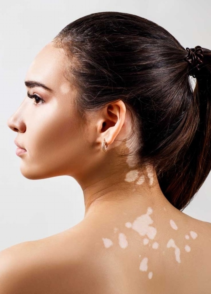 البهاق هو حالة جلدية مزمنة تؤدي إلى تلف مناطق الجلد