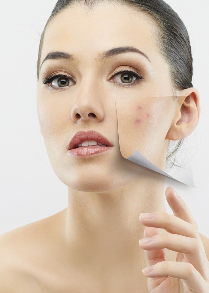 احصلي على بشرة خالية من أي عيوب من خلال الليزر الكربوني