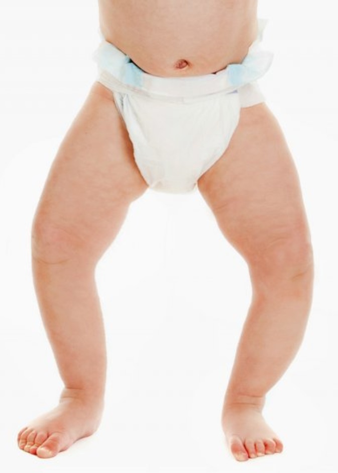 اسباب لين العظام عند الاطفال وطرق علاجه والوقاية منه