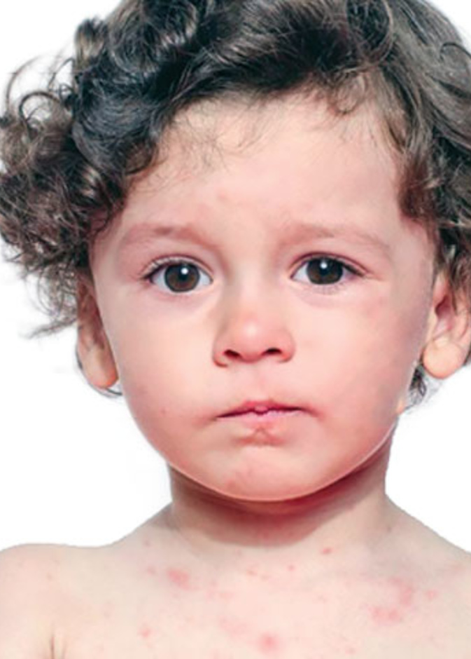 أهم اعراض الجدري المائي عند الاطفال ومخاطره