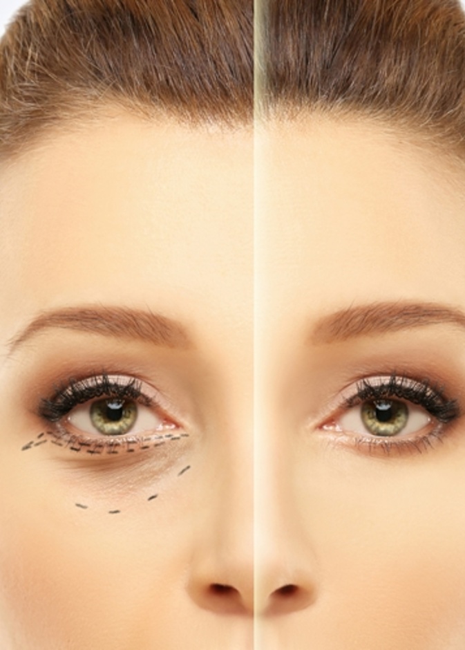  فوائد حقن الهيالورنيك للهالات السوداء