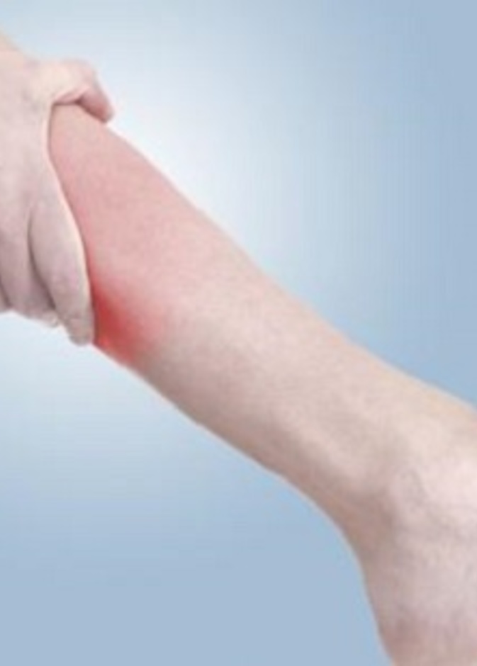 الدوالي عند النساء