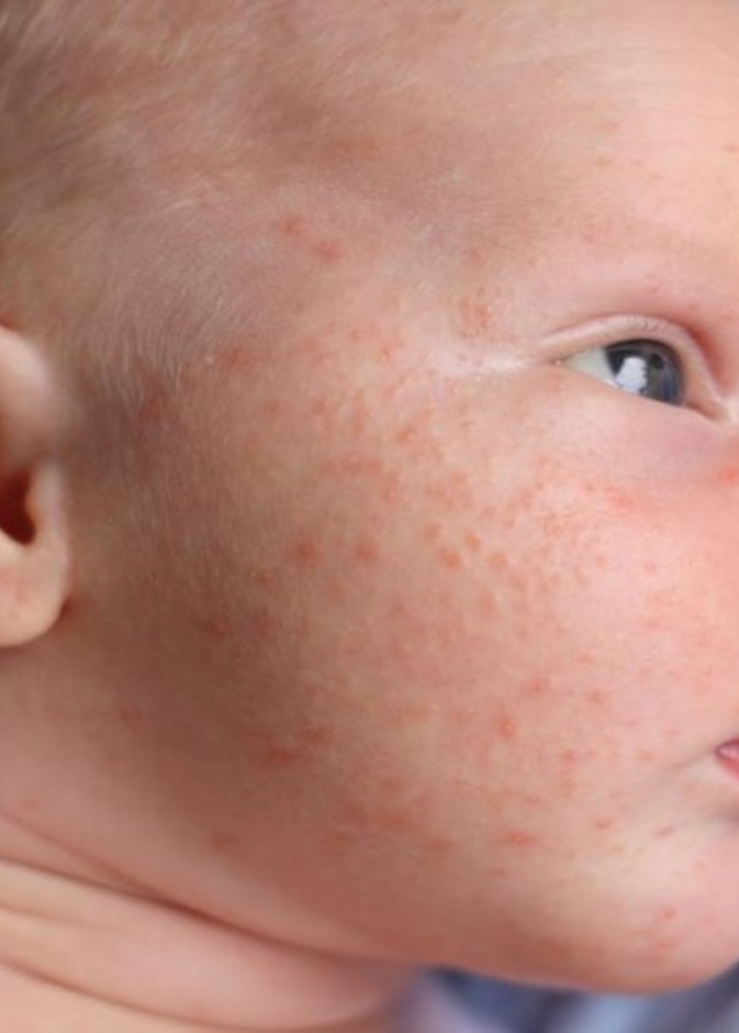 حبوب الوجه لدي الرضع