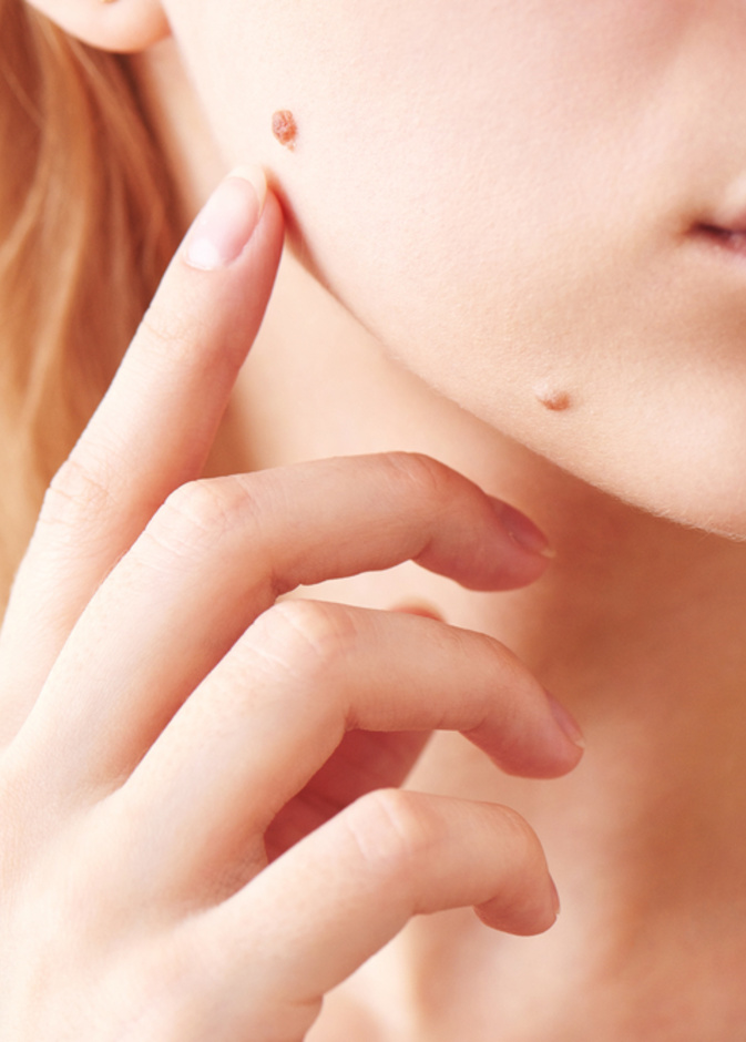 ازالة الشامة