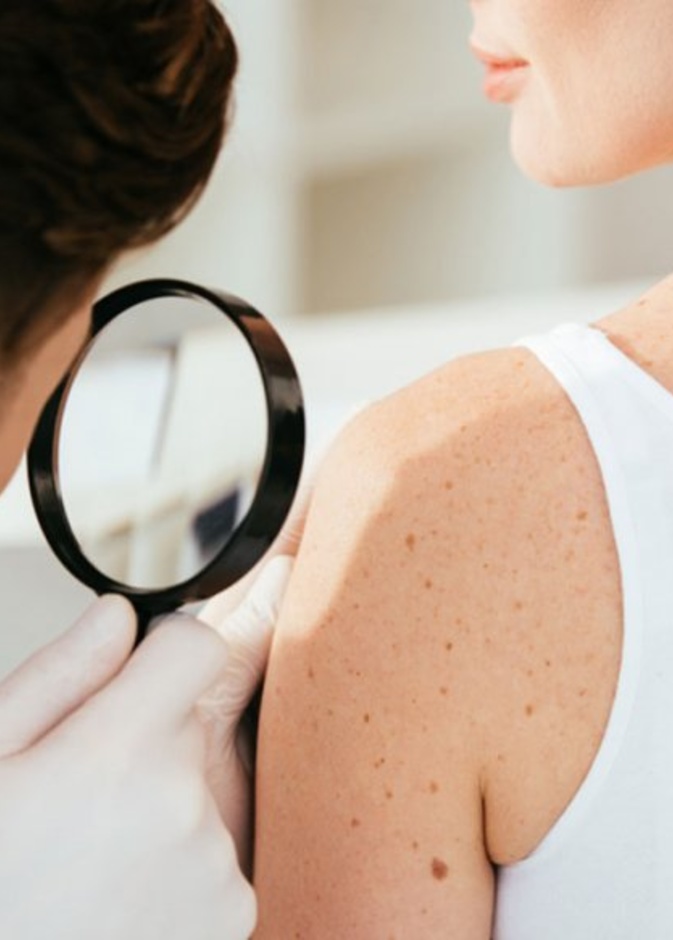 الشامات يمكن أن تتحول إلى سرطان في الجلد