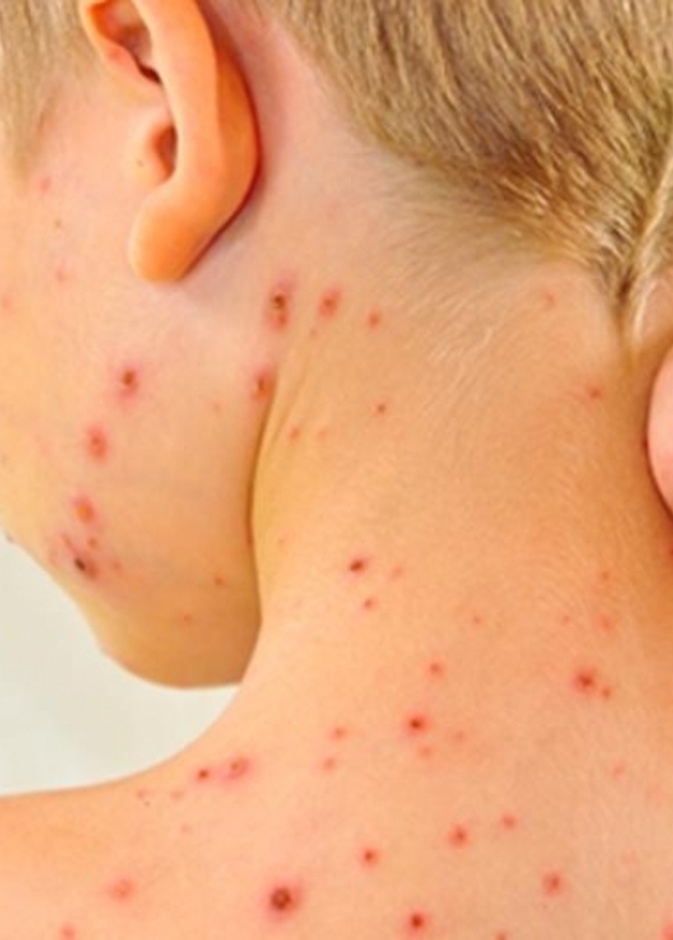 اعراض الحصبة الالمانية عند الاطفال وطرق علاجها